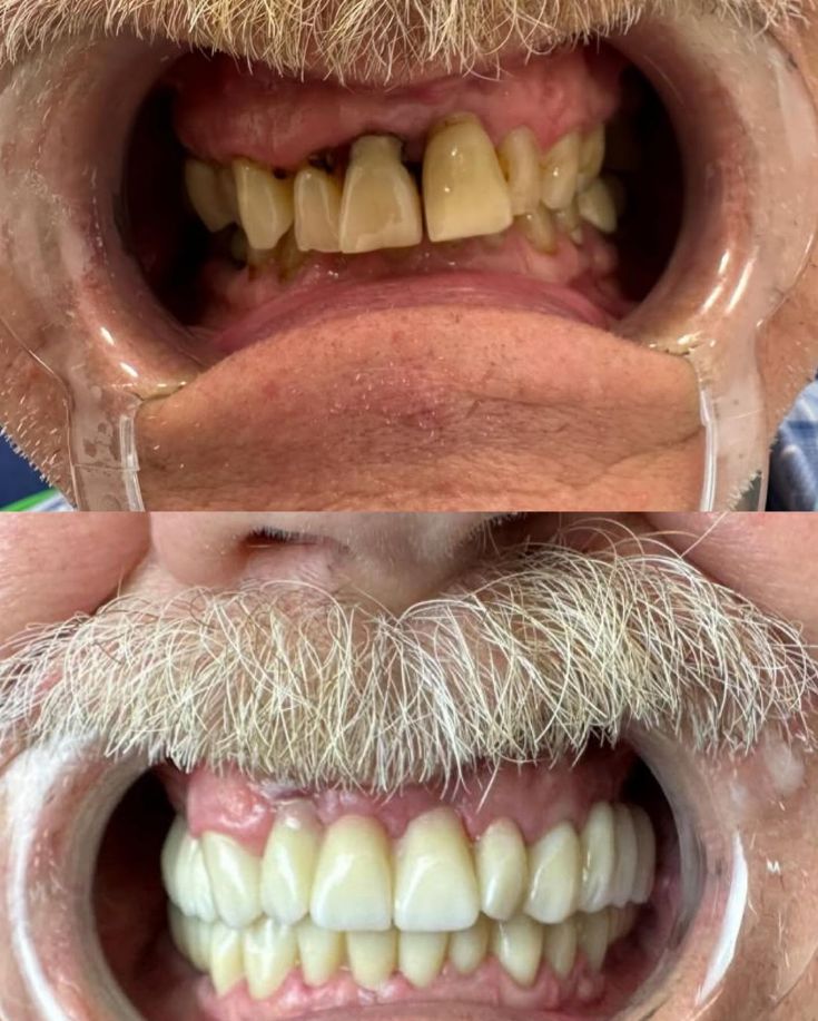 _______impianti-dentali-corone-albania-15