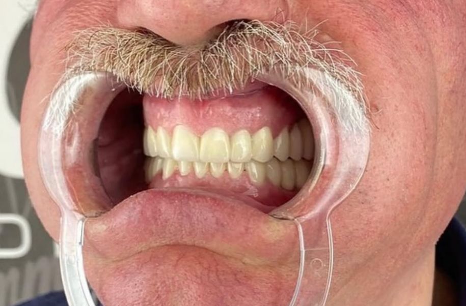 _______impianti-dentali-corone-albania-18