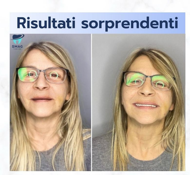 _______impianti-dentali-corone-albania-182