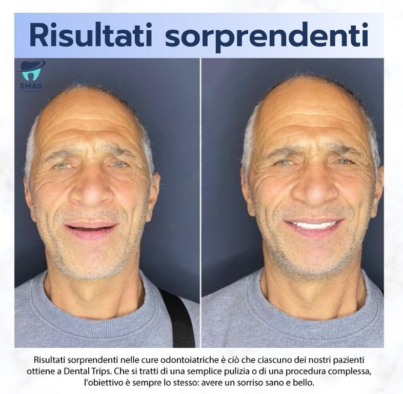 _______impianti-dentali-corone-albania-183
