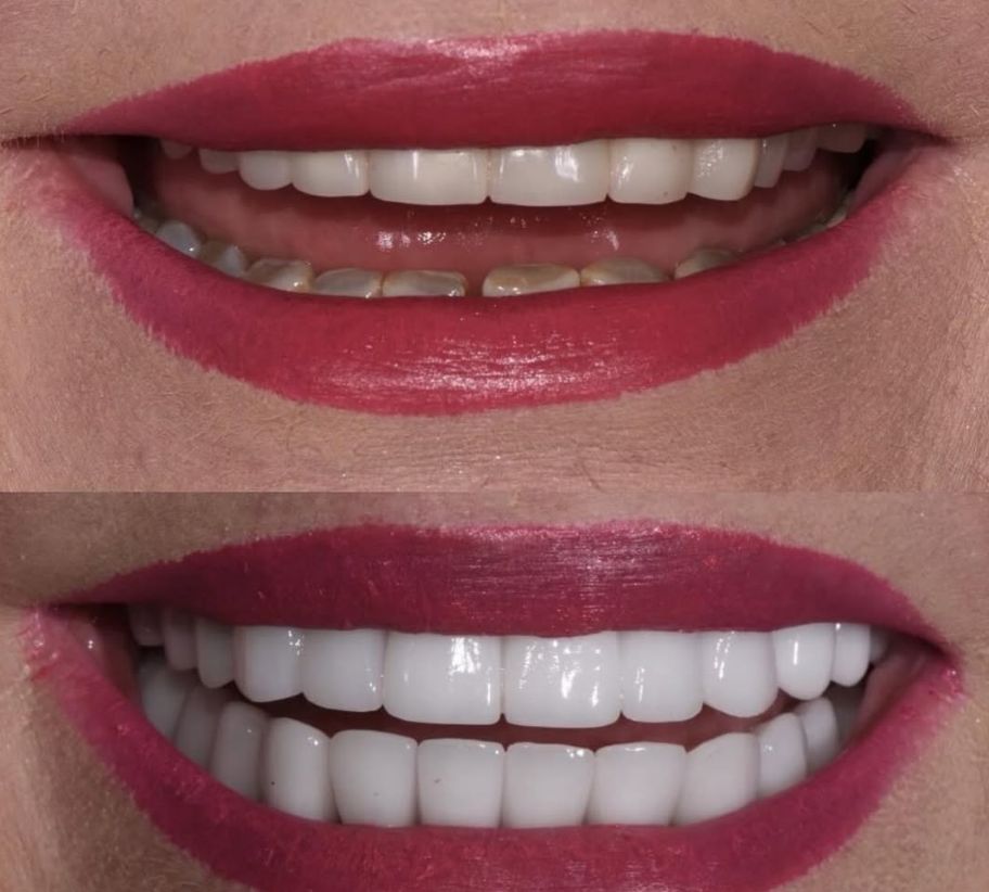 _______impianti-dentali-corone-albania-19