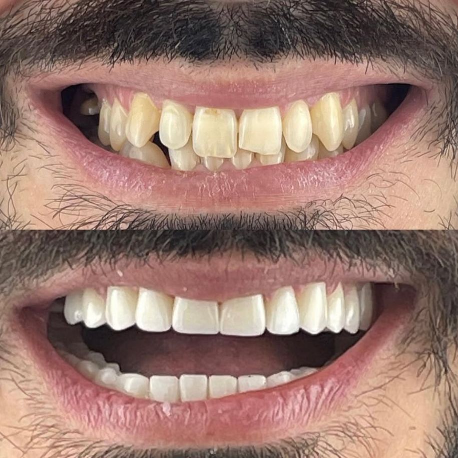 _______impianti-dentali-corone-albania-191