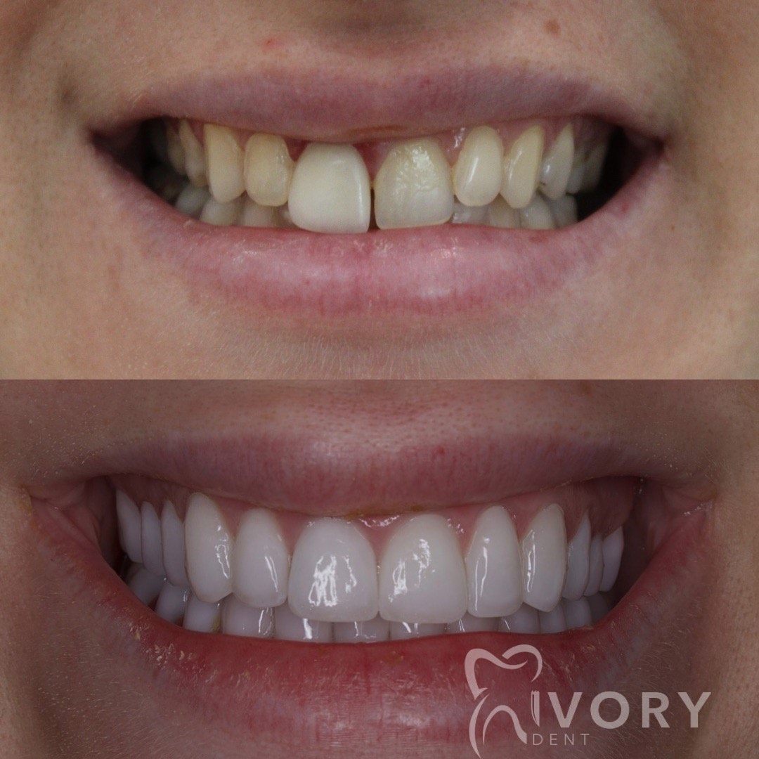 implante-dentist-dentare-kodra-diellit-1 implante-dentist-dentare-kodra-diellit-1