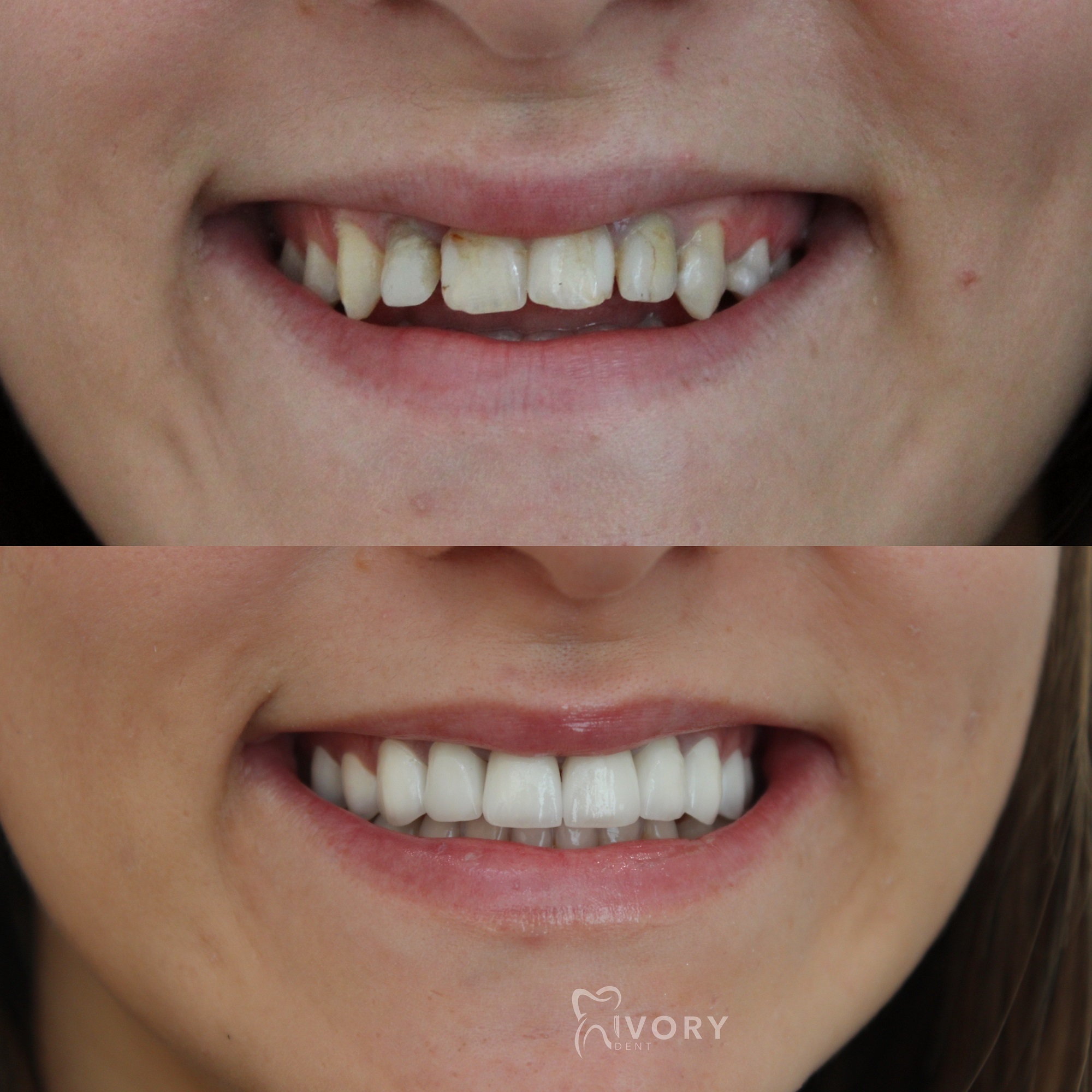 implante-dentist-dentare-kodra-diellit-11 implante-dentist-dentare-kodra-diellit-11