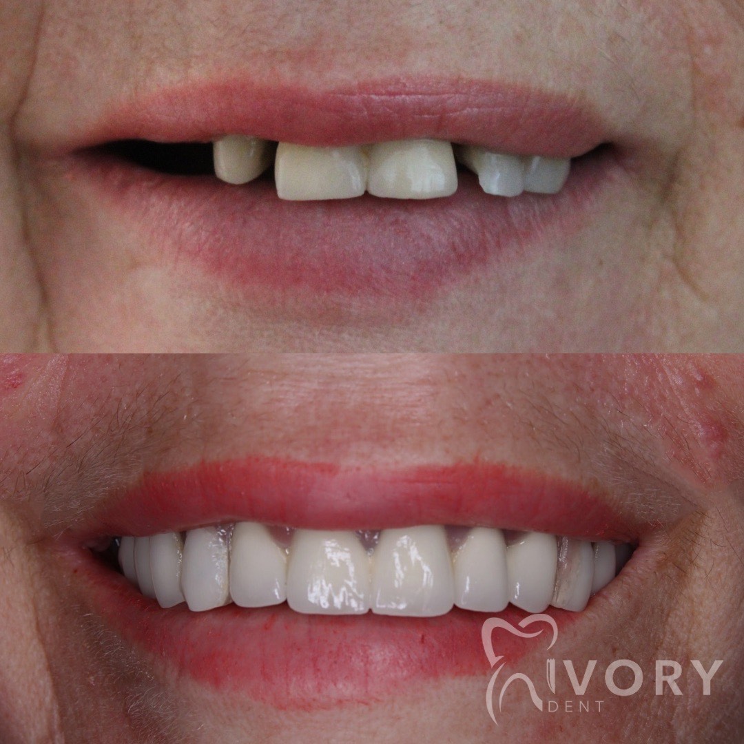implante-dentist-dentare-kodra-diellit-12 implante-dentist-dentare-kodra-diellit-12
