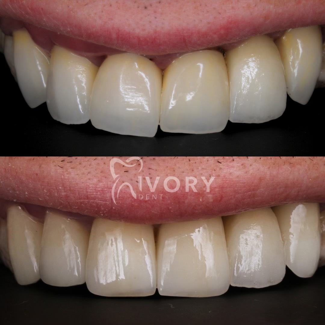 implante-dentist-dentare-kodra-diellit-13 implante-dentist-dentare-kodra-diellit-13