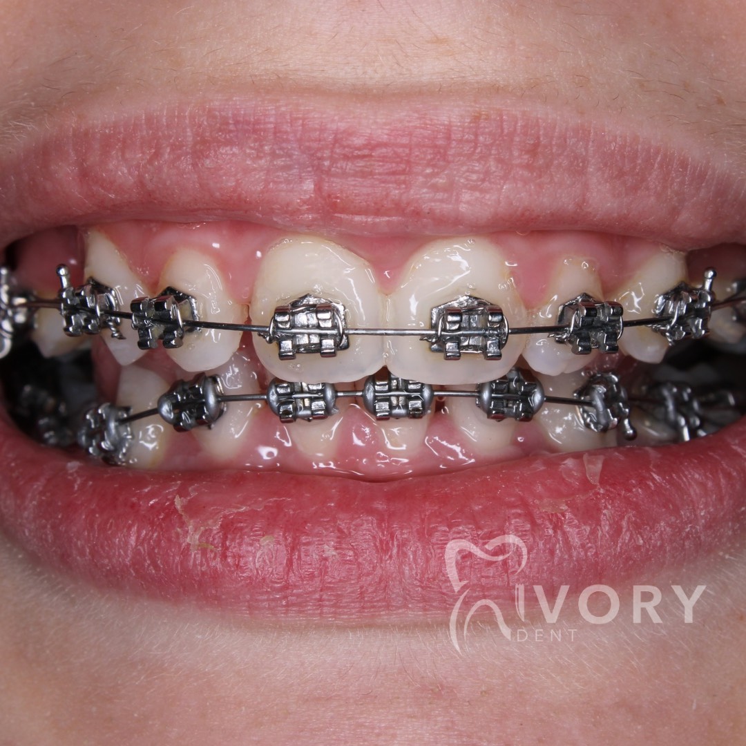 implante-dentist-dentare-kodra-diellit-15 implante-dentist-dentare-kodra-diellit-15