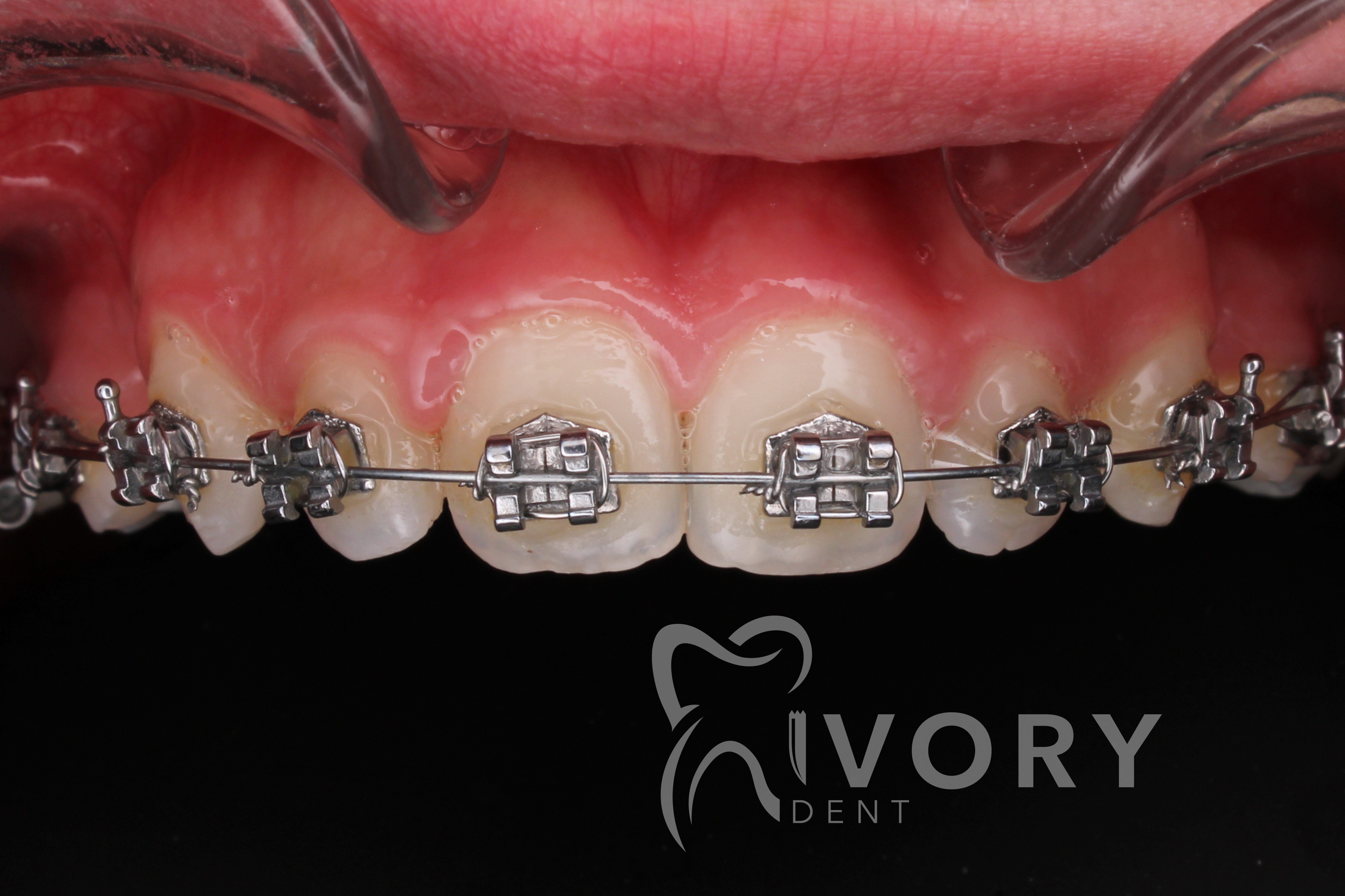 implante-dentist-dentare-kodra-diellit-16 implante-dentist-dentare-kodra-diellit-16