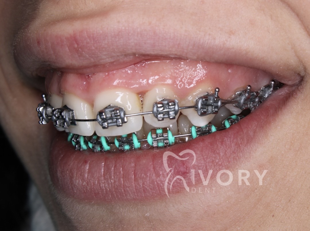 implante-dentist-dentare-kodra-diellit-17 implante-dentist-dentare-kodra-diellit-17