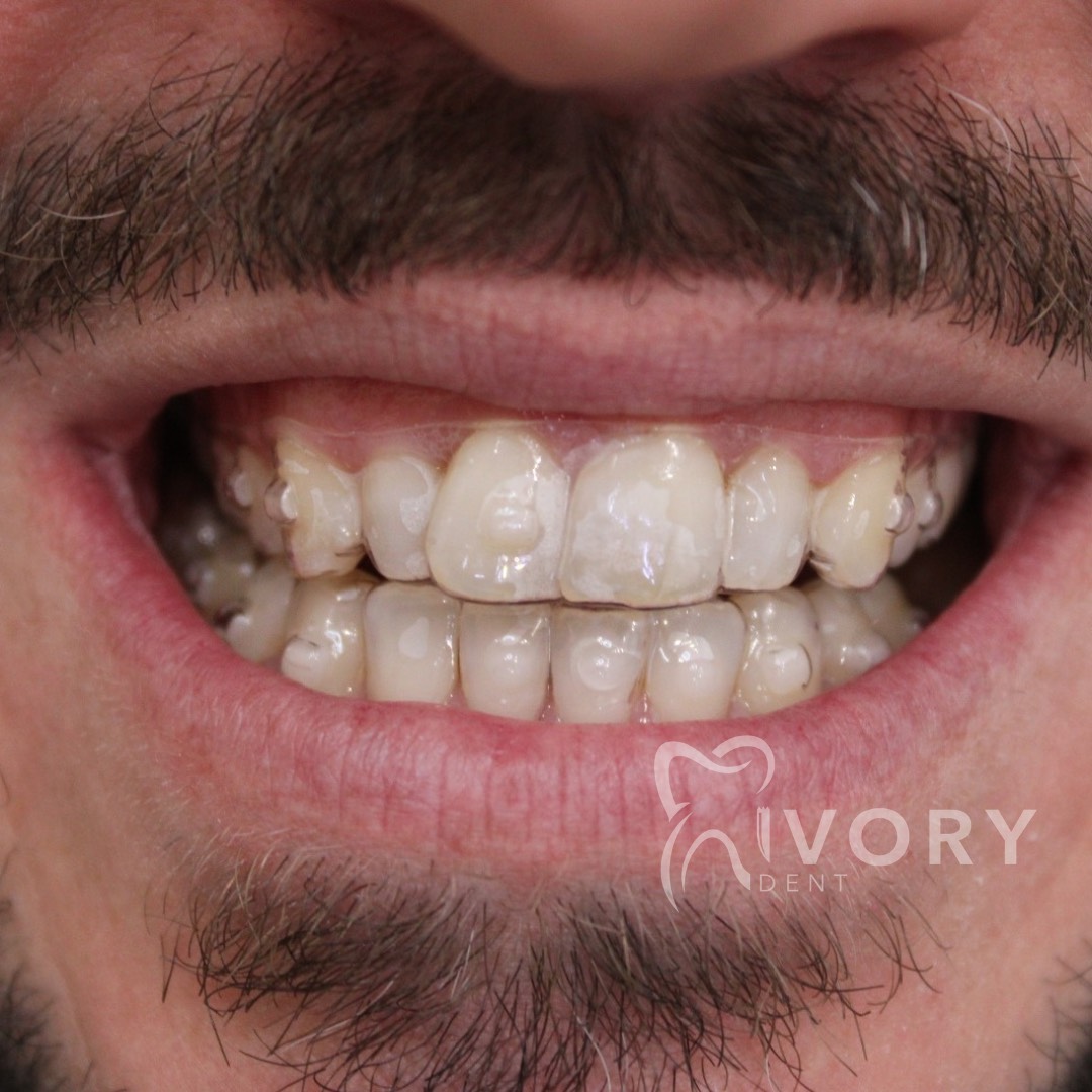 implante-dentist-dentare-kodra-diellit-18 implante-dentist-dentare-kodra-diellit-18