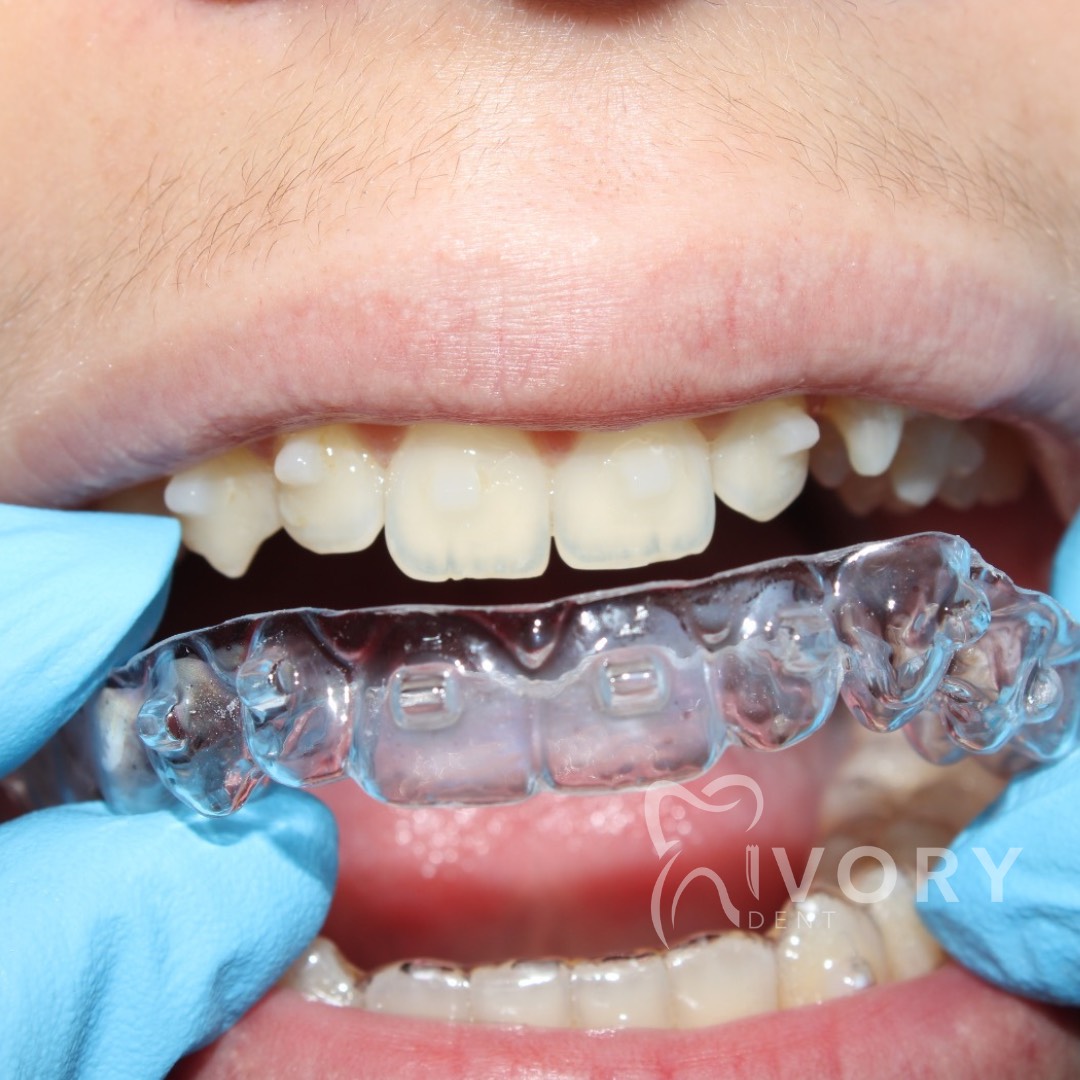 implante-dentist-dentare-kodra-diellit-192 implante-dentist-dentare-kodra-diellit-192