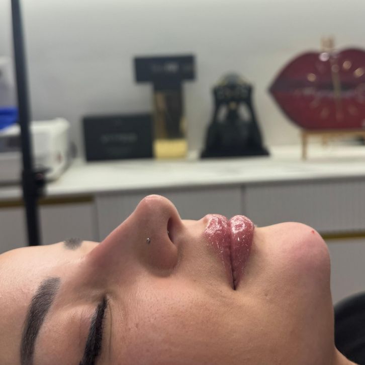 _____________filler-rimodelim-hindes-11