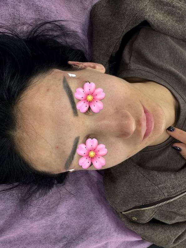 _____________filler-rimodelim-hindes-12