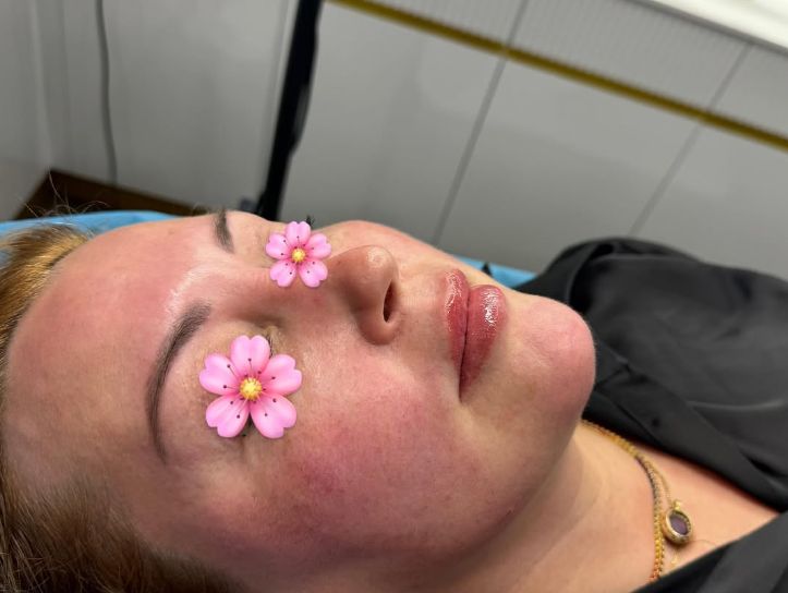 _____________filler-rimodelim-hindes-14