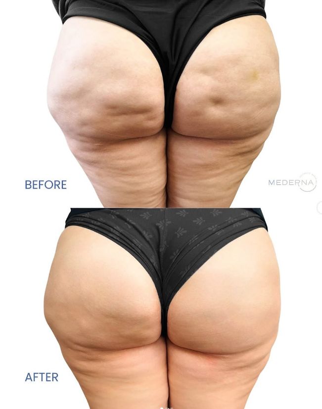 _____________filler-rimodelim-hindes-19