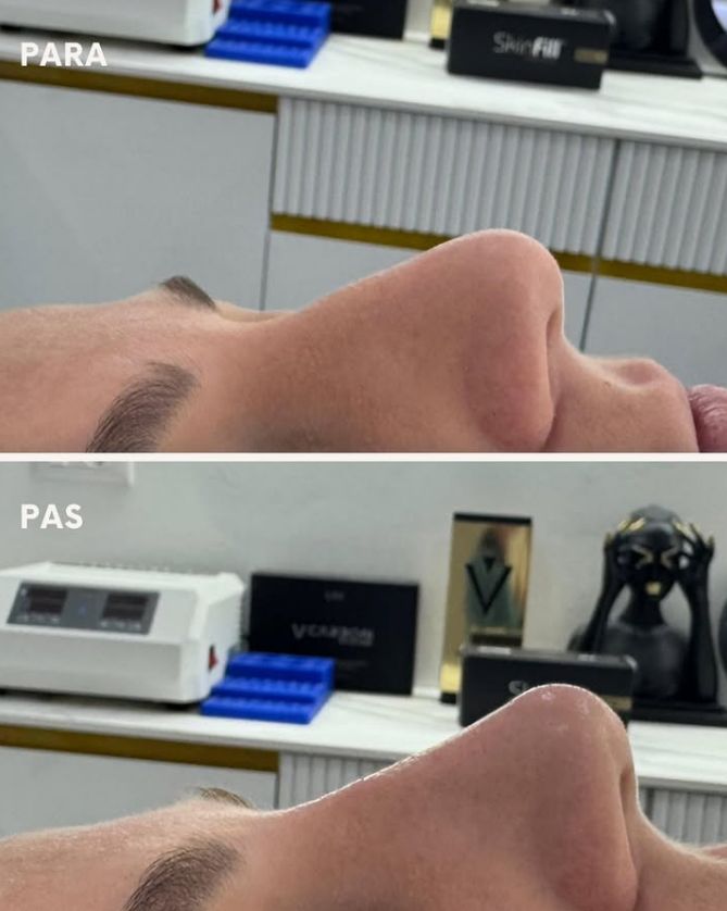 _____________filler-rimodelim-hundes-1