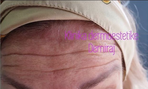 ______Trajtim-me-Botox-dures-12
