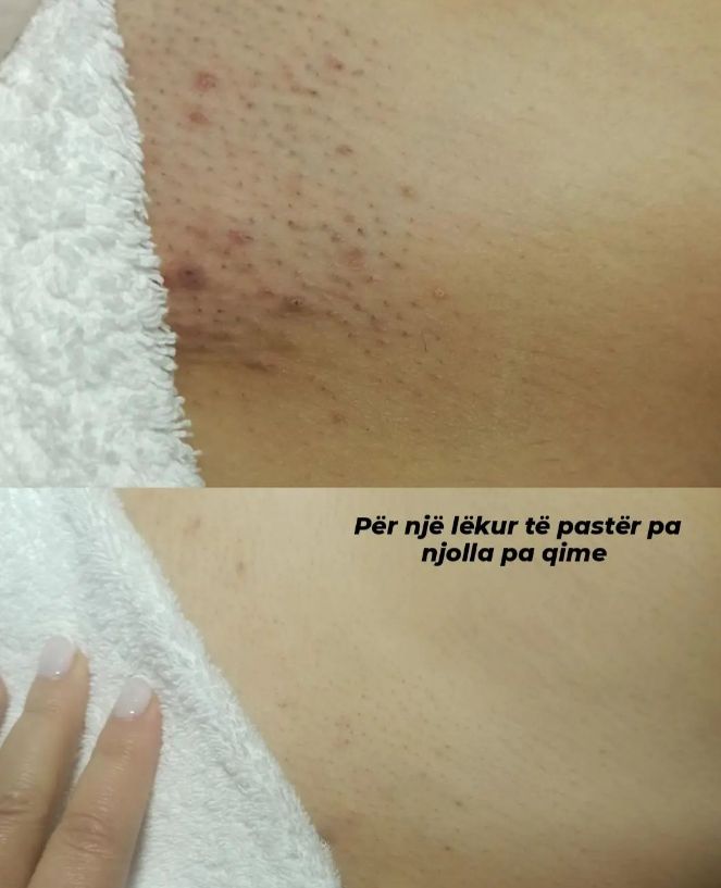 depilim-me-lazer-tirane-lezhe-shkoder-161